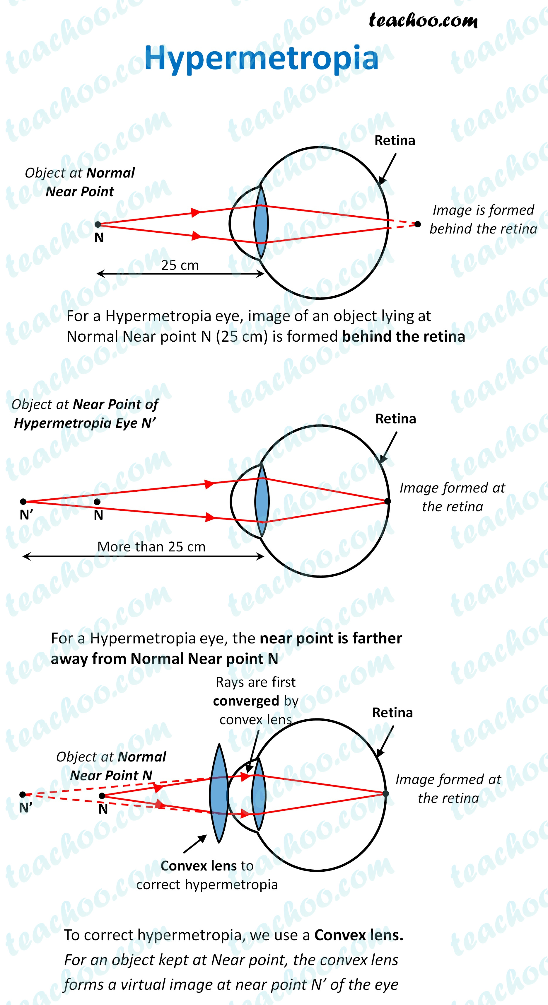 hypermetropia---teachoo.jpg