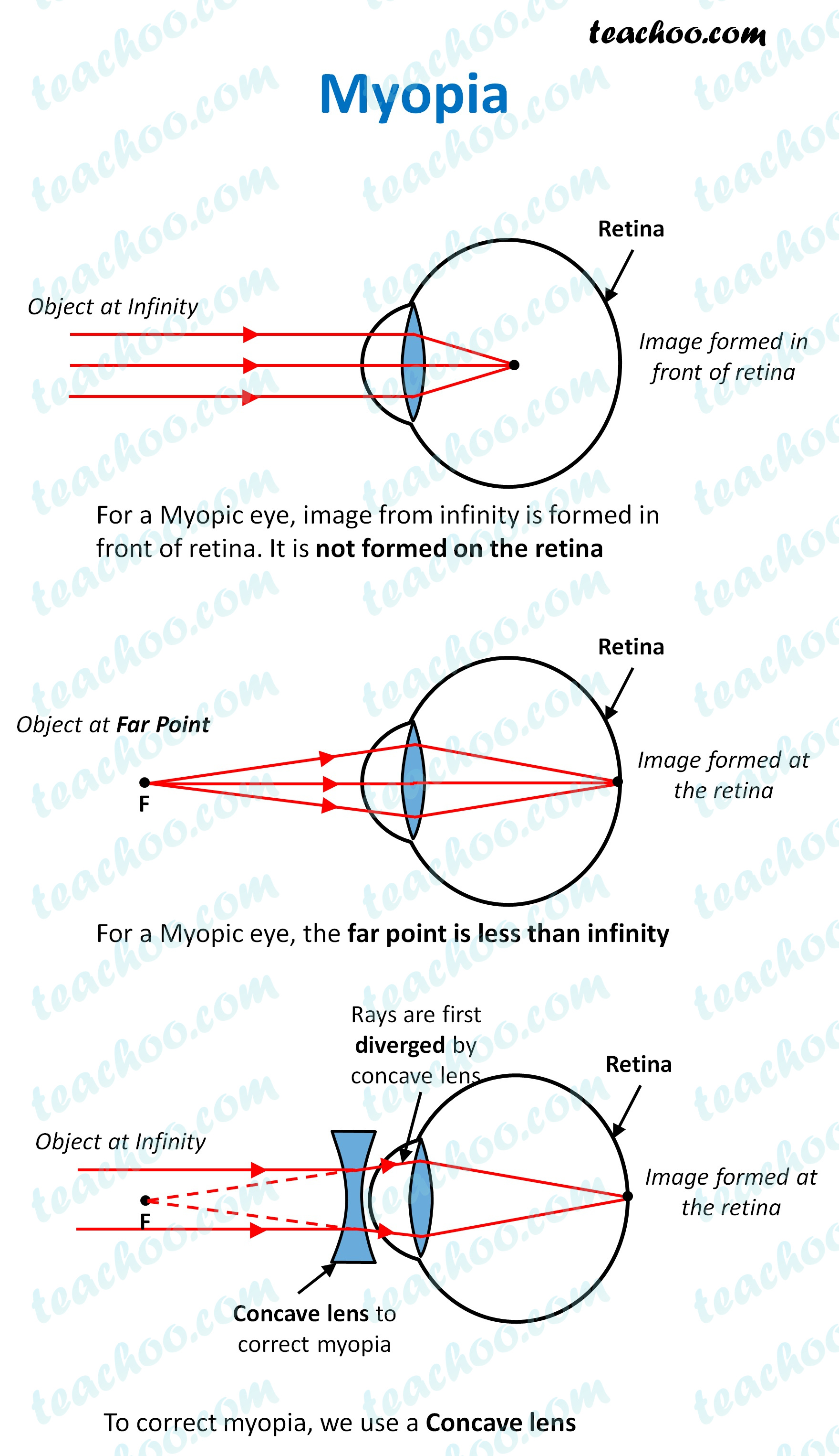 myopia---teachoo.jpg